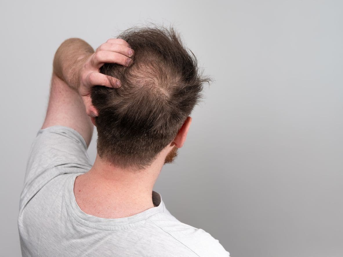 Hair Loss medical condition treated at Prime Health MD